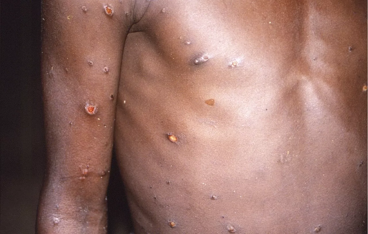 Mpox : Pourquoi l’OMS déclenche son plus haut niveau d’alerte sur la variole du singe