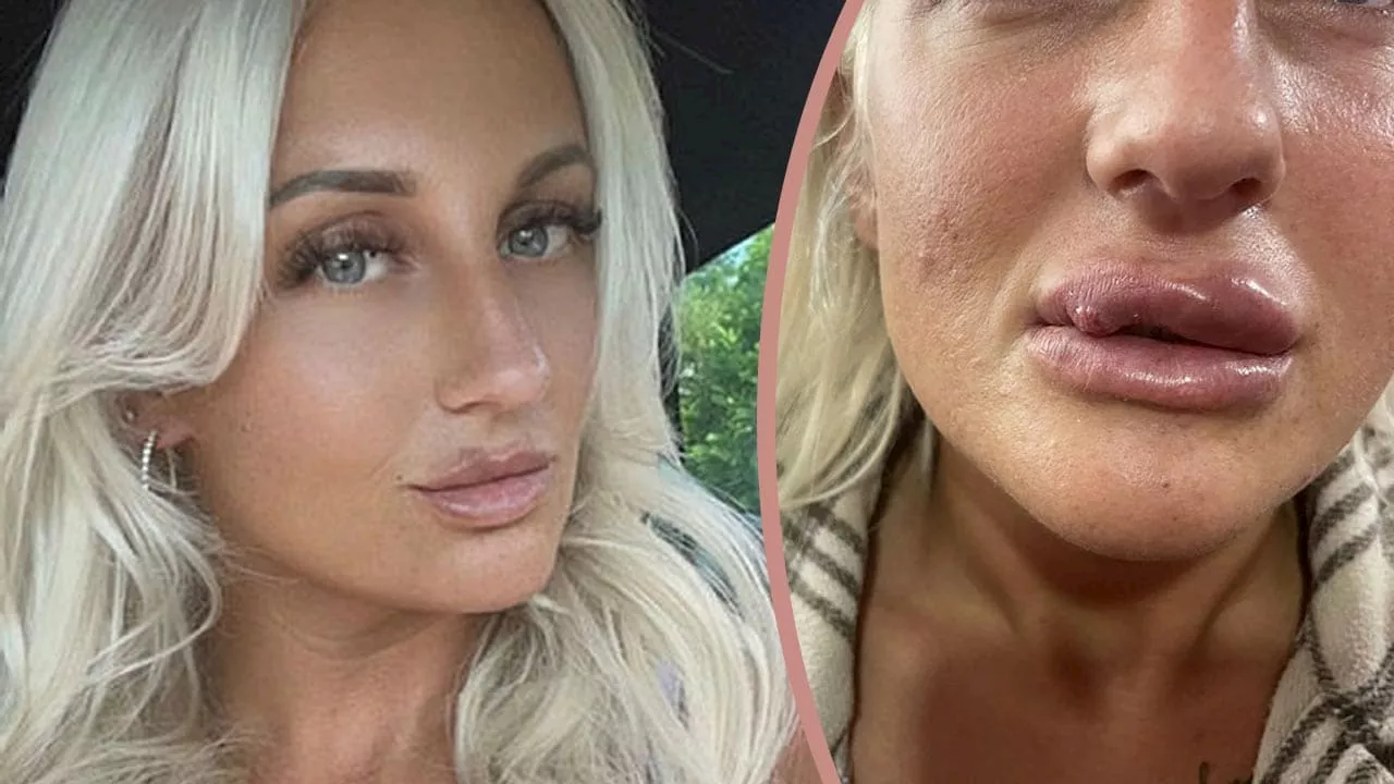 Arzt spritzt Hyaluron falsch! Nicole (30): „Meine Lippen faulen“