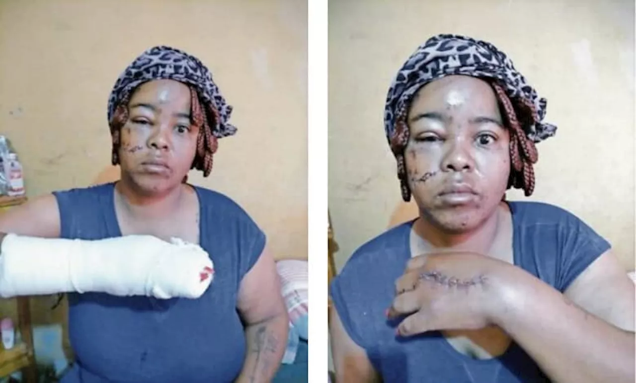 Video: Badly beaten woman’s case back on Emalahleni court roll