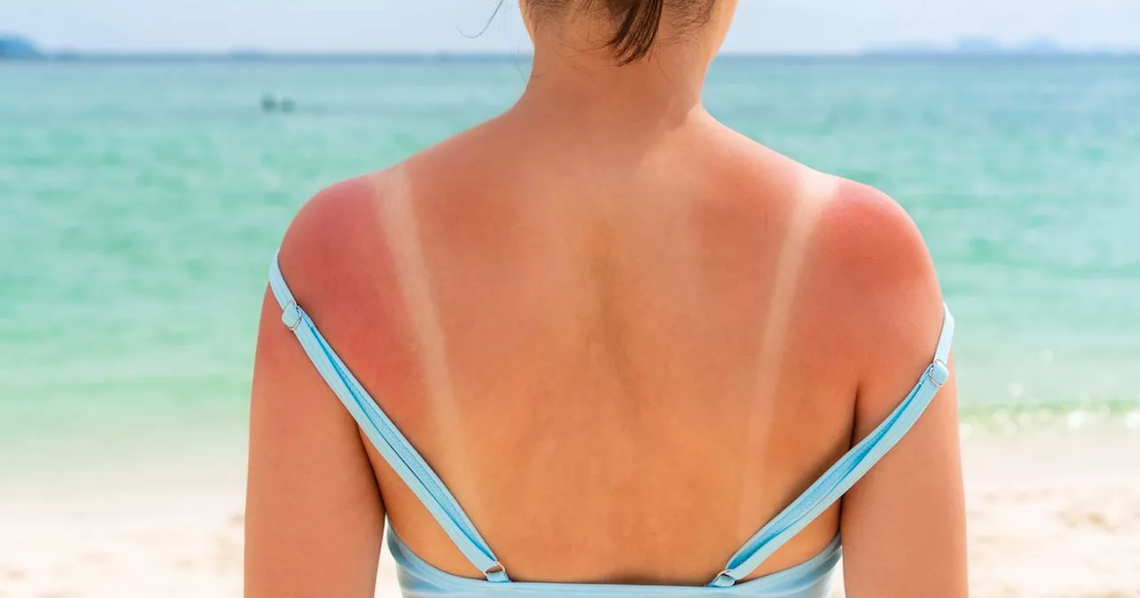 Best moisturisers to treat sunburn - and one you must avoid