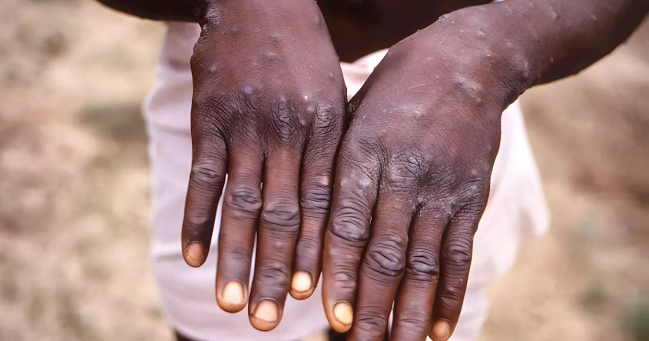 Mpox cases are soaring in Africa – what must be done to prevent a global pandemic