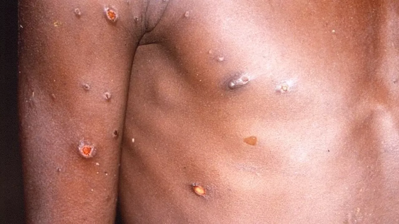 África declara la emergencia de salud pública continental por el brote de mpox