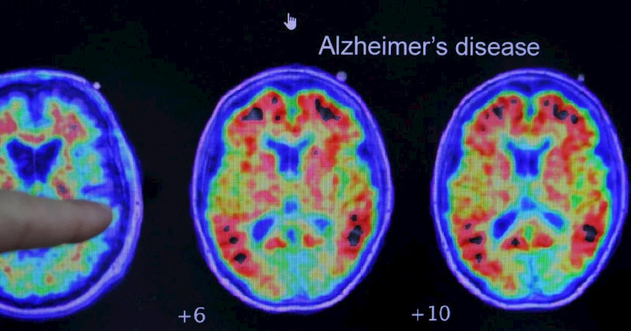 Risikofaktoren bei Alzheimer: Studie betont Rolle von Geschlecht und Untätigkeit