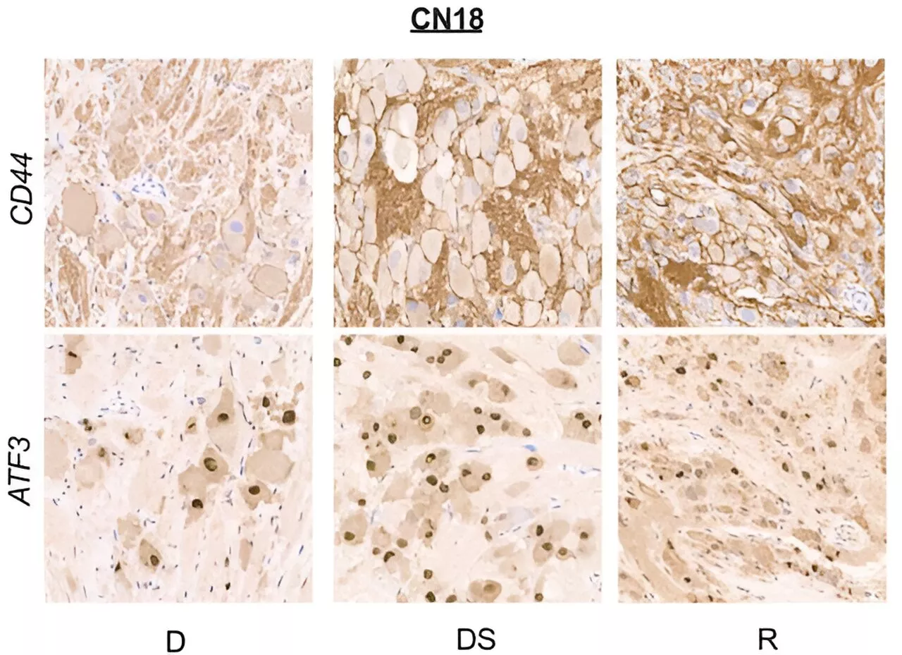 Researchers identify malignant cells responsible for relapse in high-risk neuroblastoma