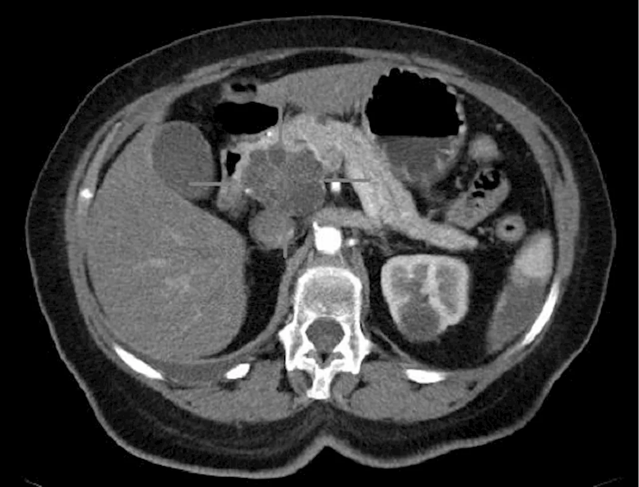 Study of fasting and ketogenic diet reveals a new vulnerability of pancreatic tumors