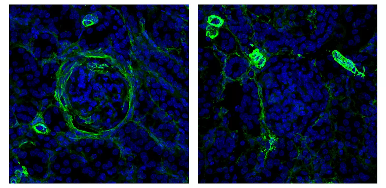 Surprising mechanism of lupus kidney damage identified