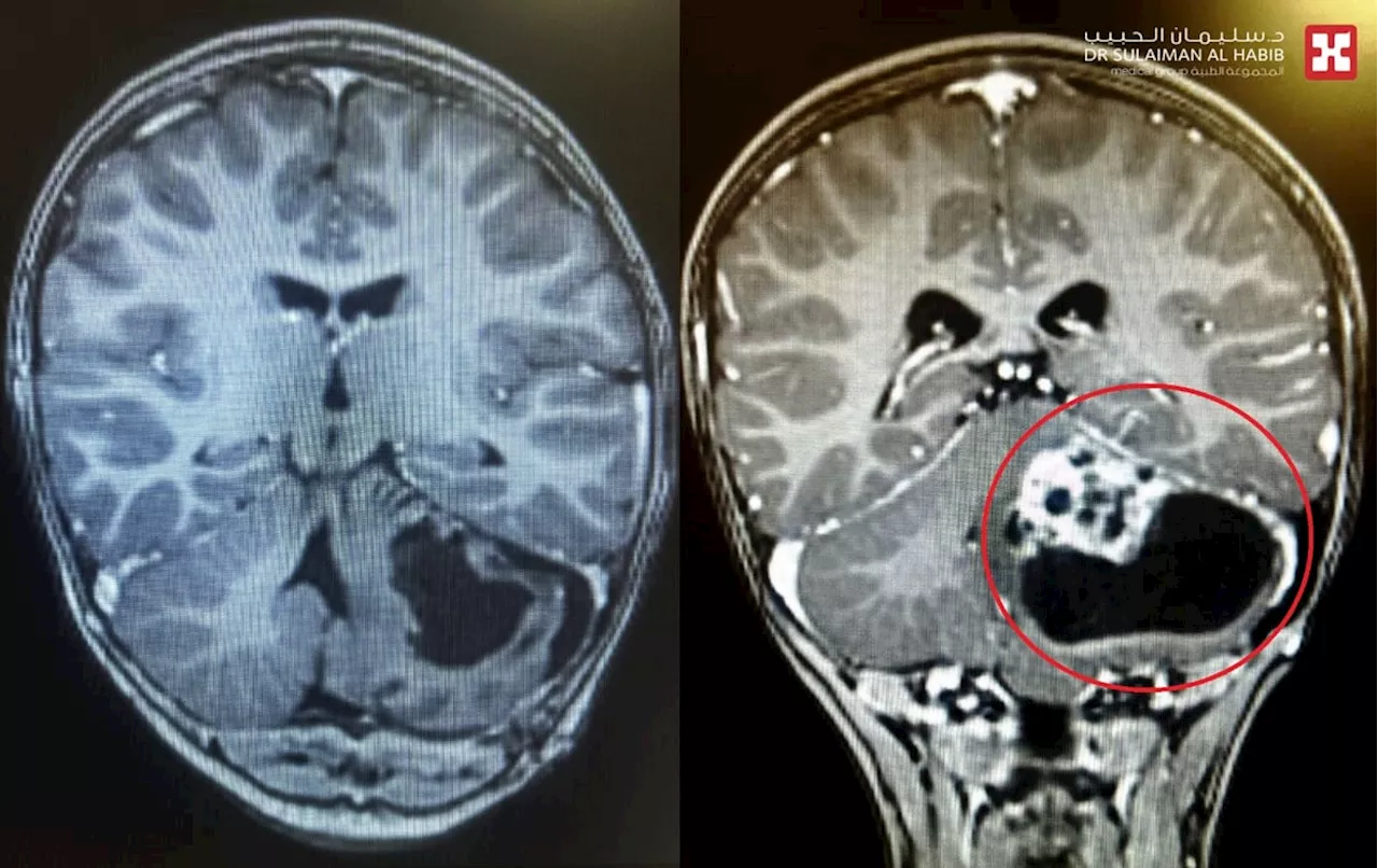مستشفى الدكتور سليمان الحبيب بالخبر يُنهي معاناة طفل مع ورم متشعب في المخ بتقنيات حديثة