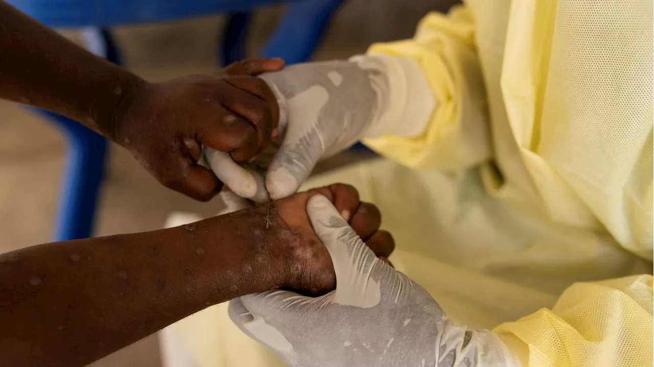 Ausbreitung des Mpox-Virus: WHO ruft weltweite Notlage aus