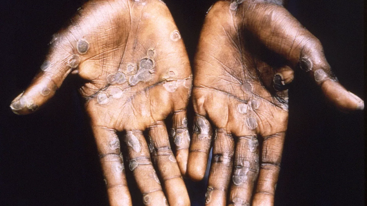 Mutant mpox outbreak declared emergency in Africa after rapid spread to 13 countries