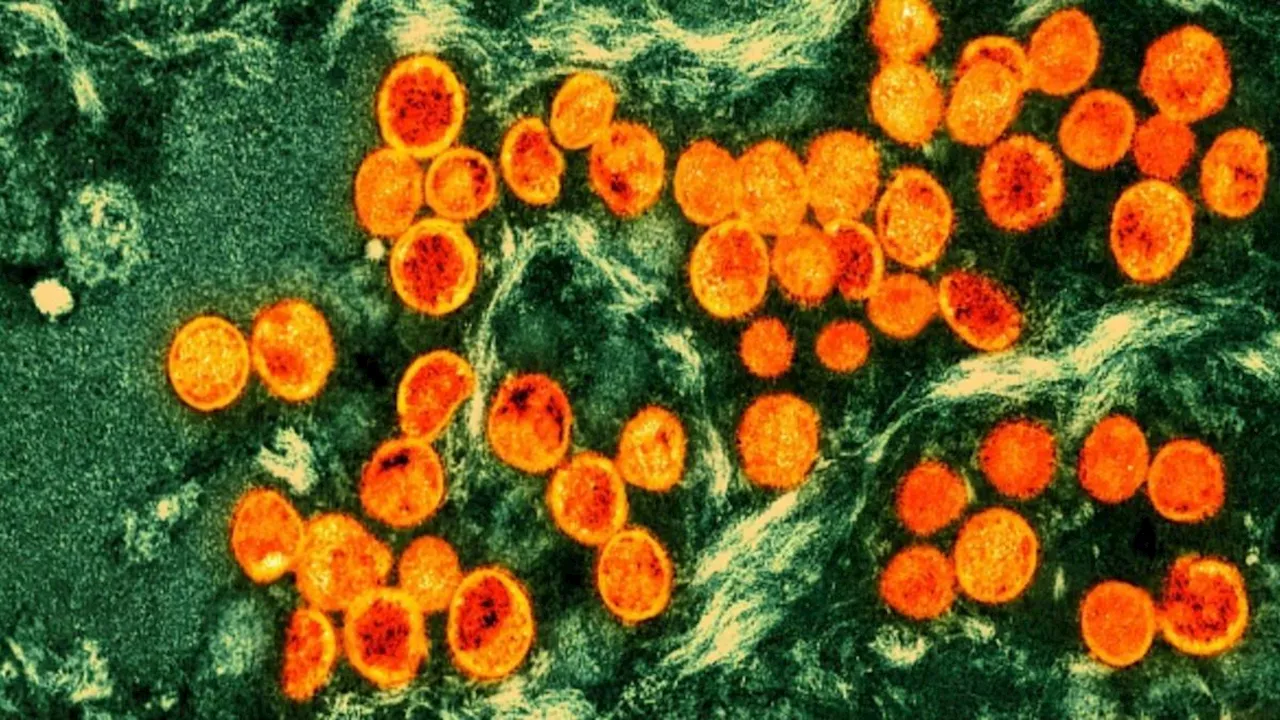 Sweden finds mpox variant first identified in DR Congo