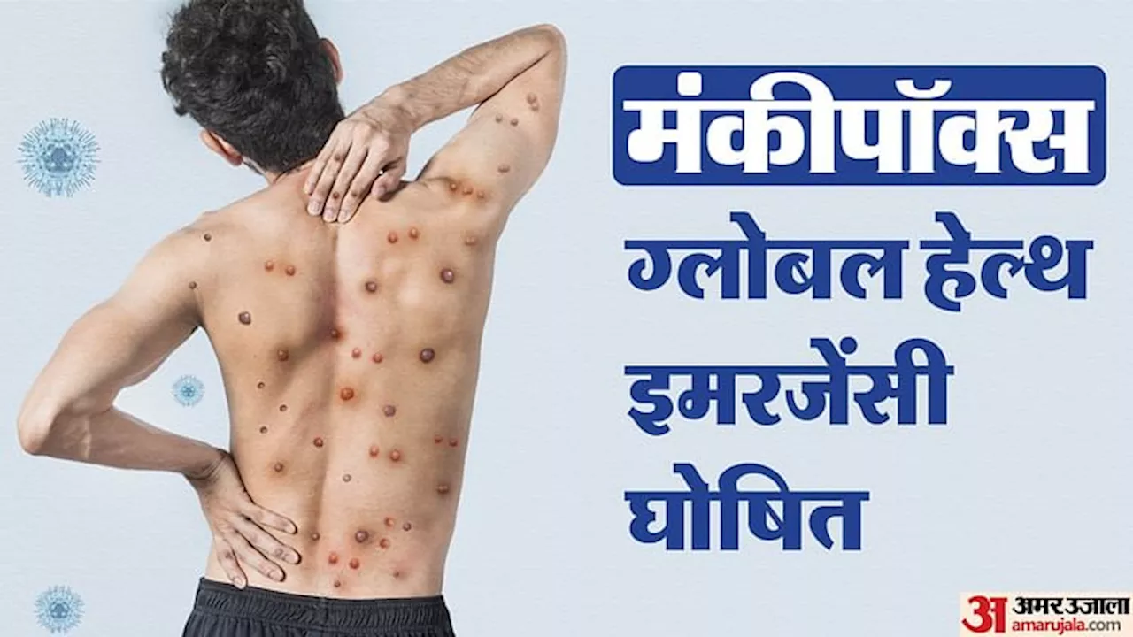 Mpox Virus: स्वीडन में मिला मंकीपॉक्स का क्लैड I वैरिएंट; अफ्रीका से बाहर पहला मामला, WHO ने जताई चिंता