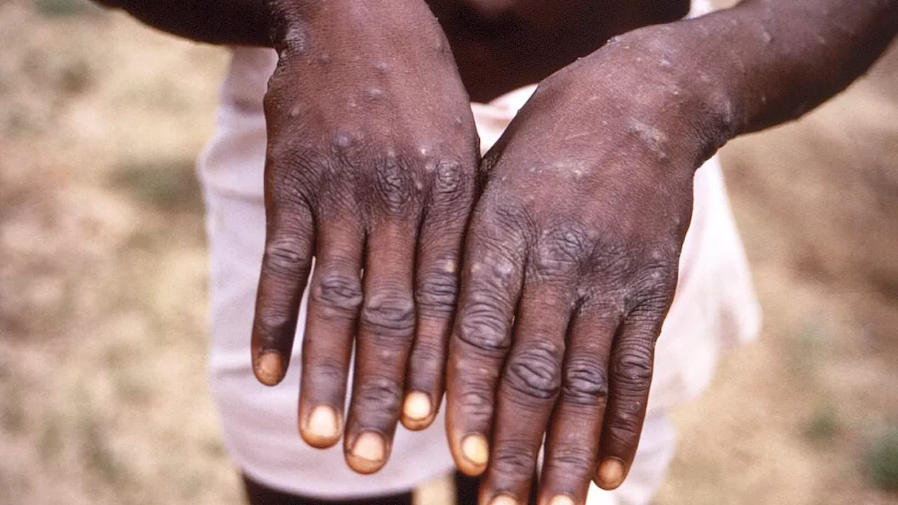 World Health Organization declares ultra-deadly monkeypox strain a public health emergency of...