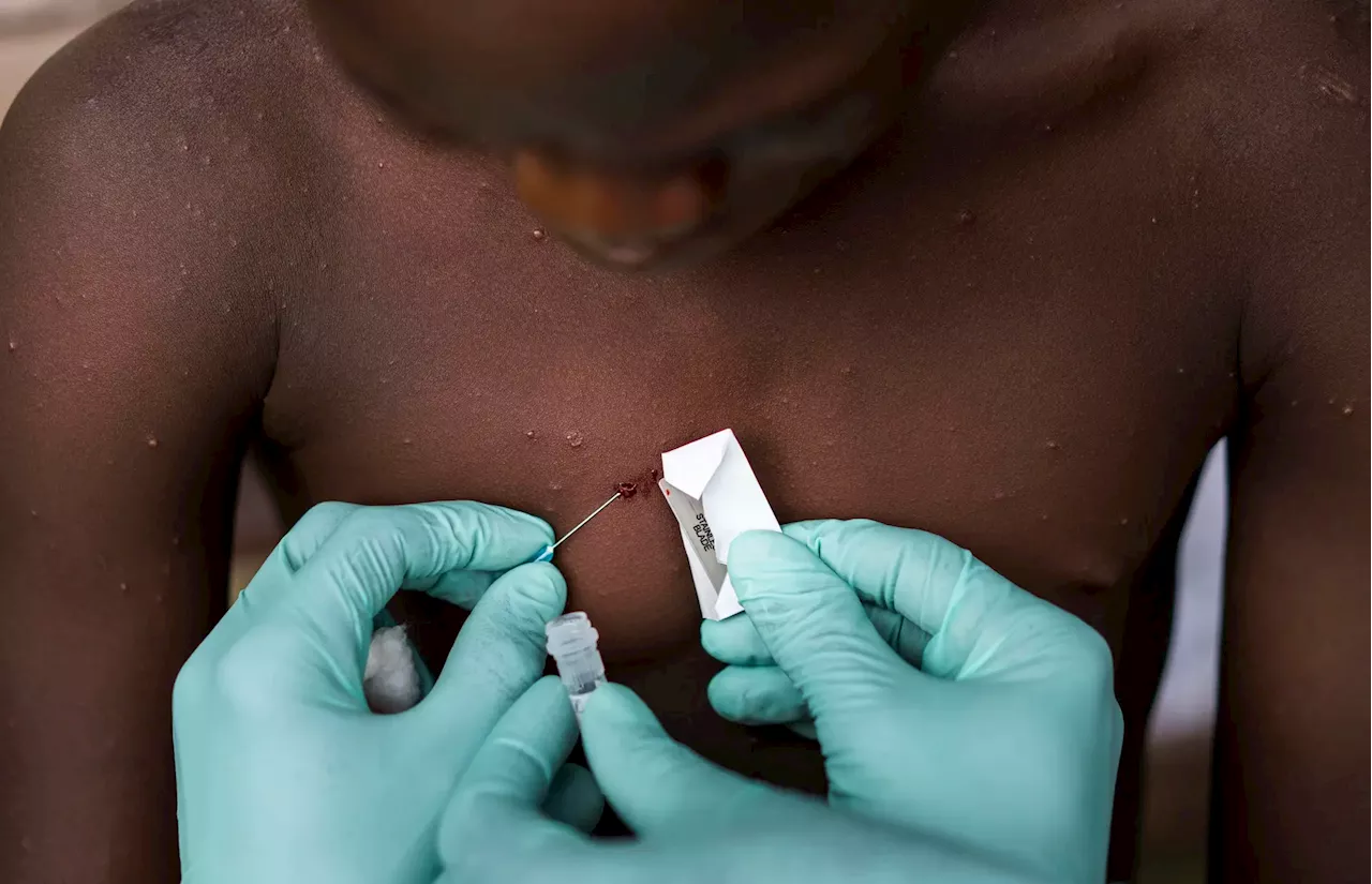 Epidemia de mpox matou 548 pessoas na República Democrática do Congo desde o início do ano