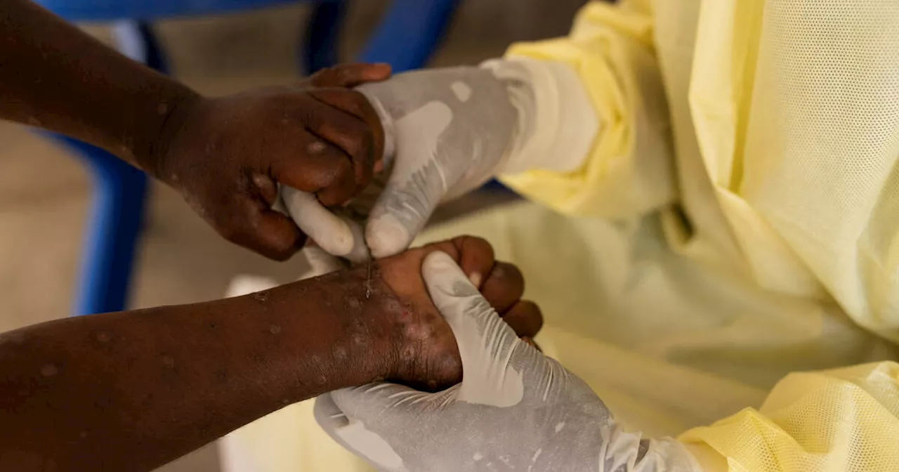  Mpox : le nouveau variant découvert en Suède, une première hors d’Afrique