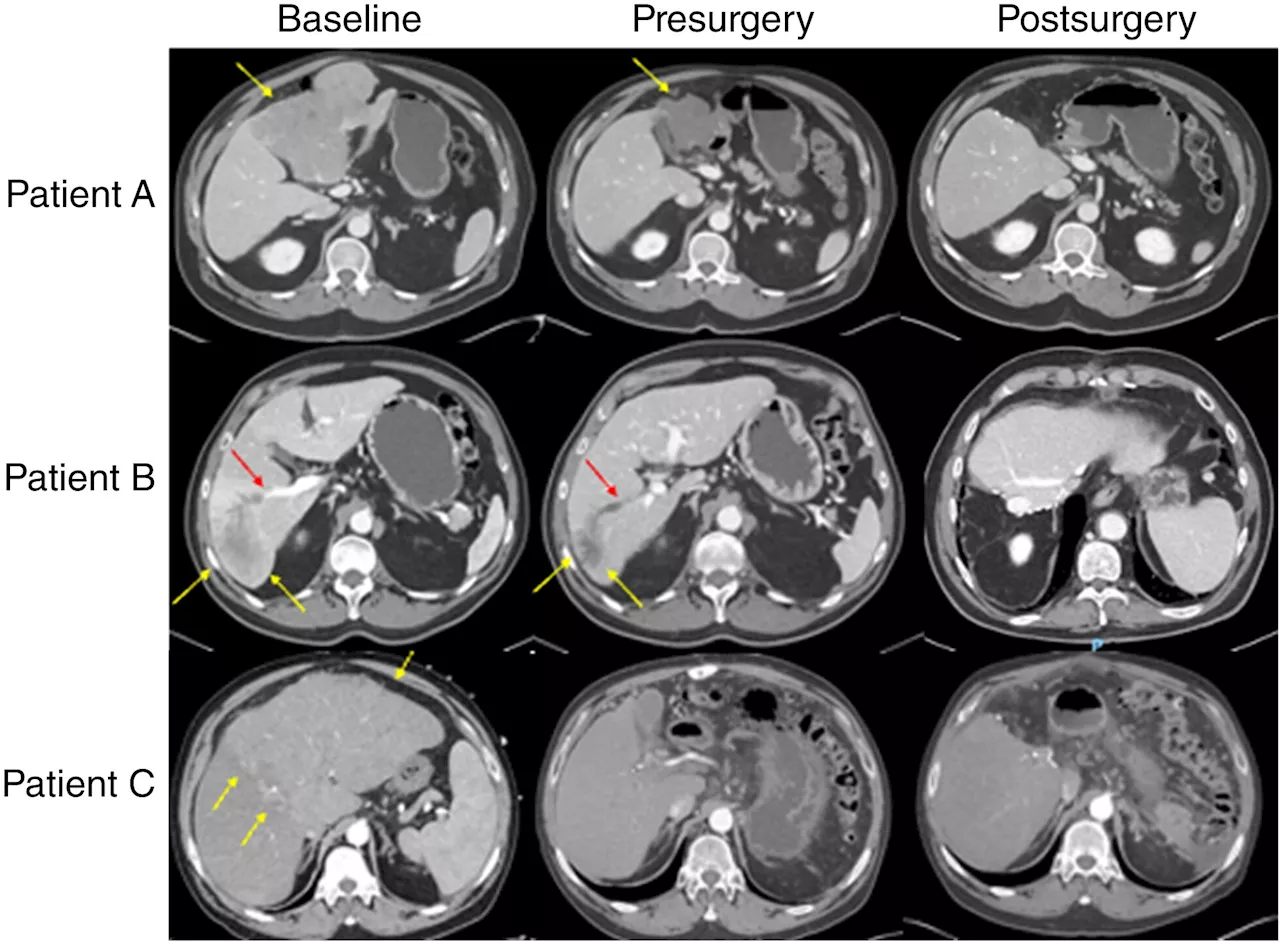 Neoadjuvant immunotherapy may facilitate surgery, improve outcomes for patients with high-risk liver cancer