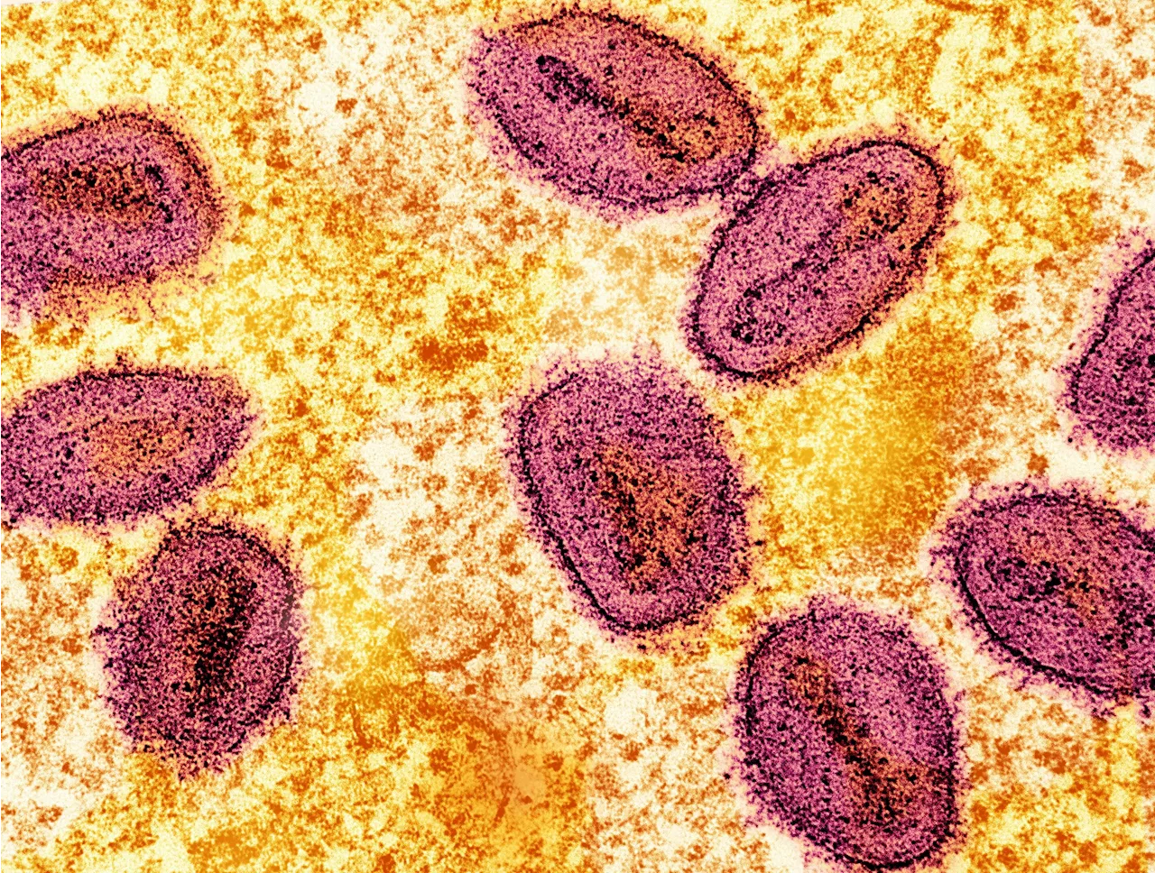 WHO warns more mpox to come in Europe after case in Sweden