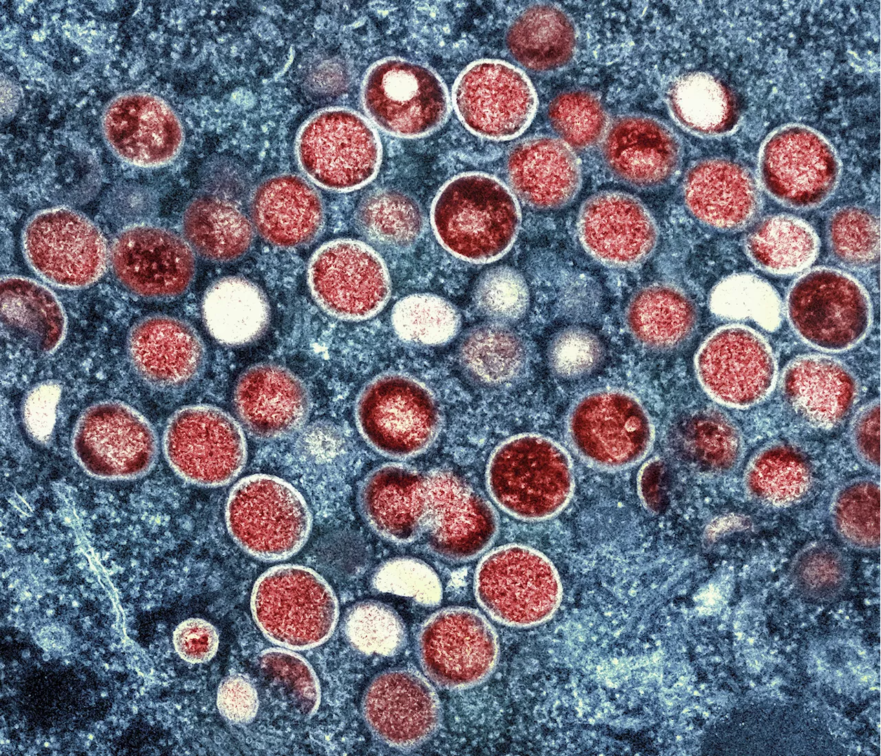 Sweden Reports First Case of Mpox Strain Outside of Africa