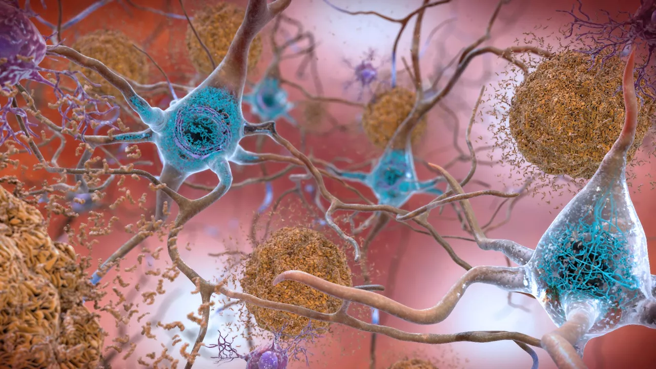 The Real Cause of Alzheimer’s Might Not Be Amyloid: Groundbreaking Discovery Challenges Decades-Old Theories