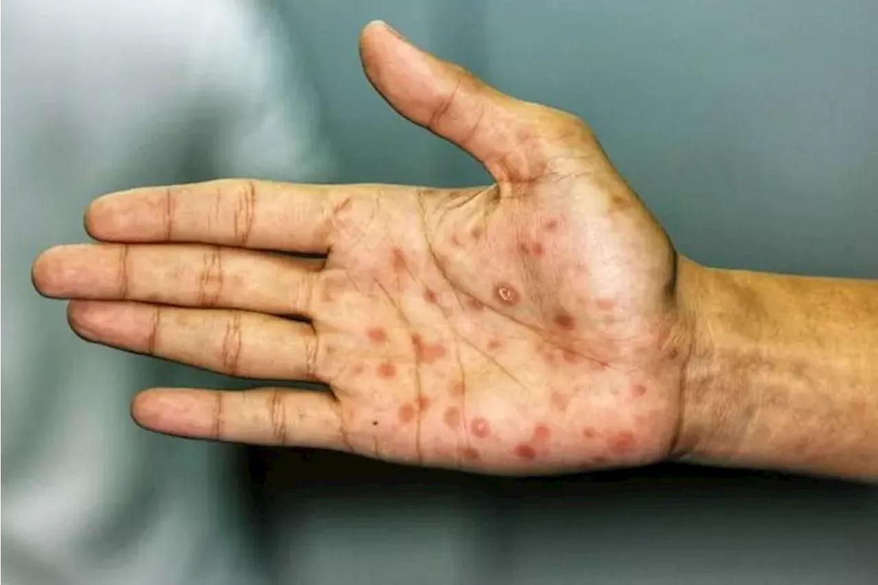 Malaysia recorded nine monkeypox cases to date, all in 2023, says Health Ministry