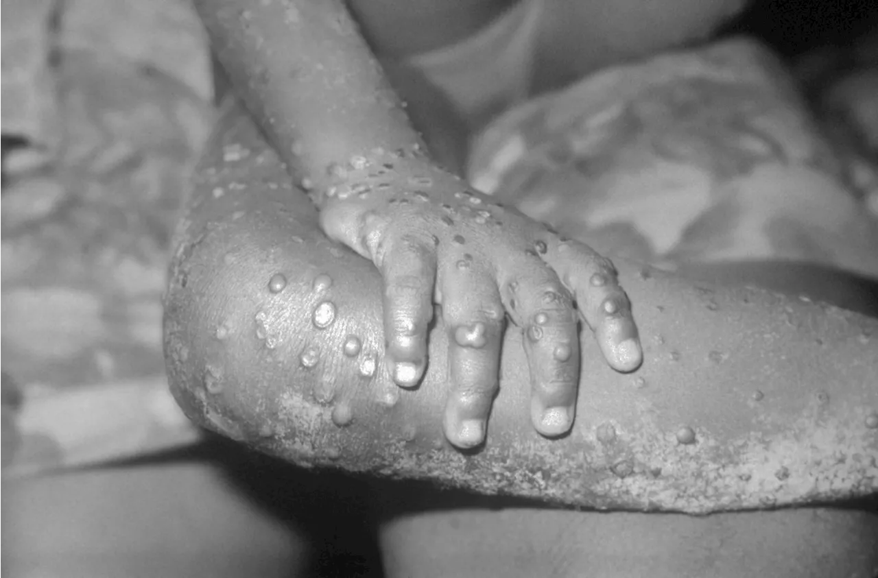 Saiba quais são os países com mais casos de mpox no mundo