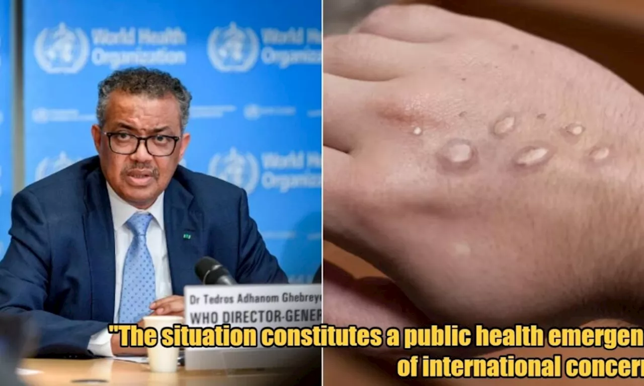 WHO: Monkeypox is Now an International Health Emergency, 925 Cases & 11 Deaths So Far in SEA