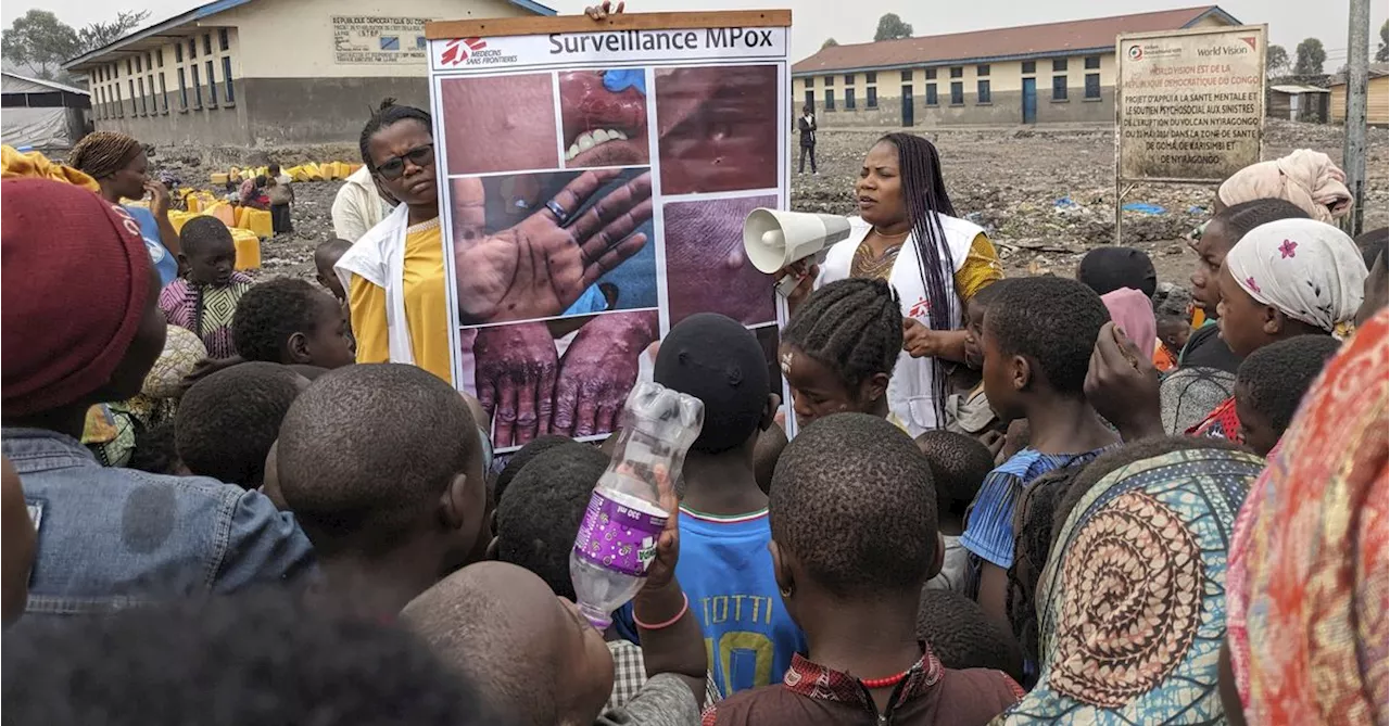 Hundreds of children dying in virulent new mpox wave