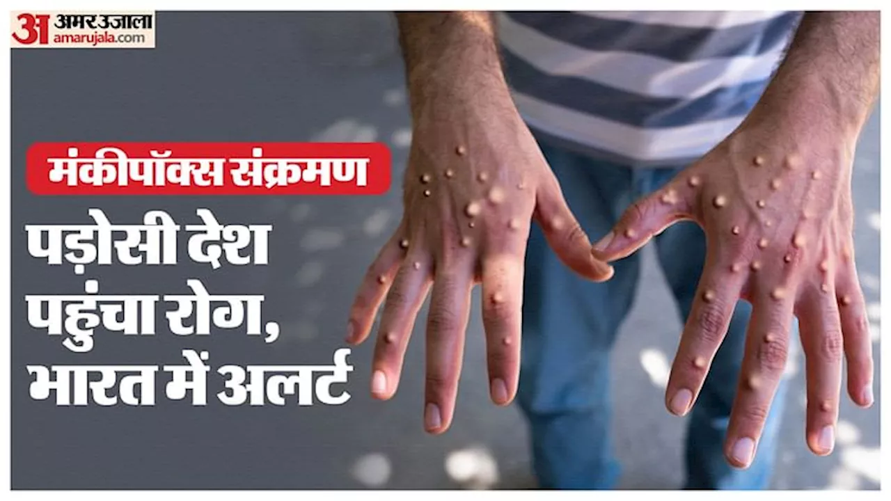 Monkeypox Infection: भारत के 'करीब' पहुंच गया एमपॉक्स संक्रमण, अफ्रीका से लेकर यूरोप तक फैला वायरस