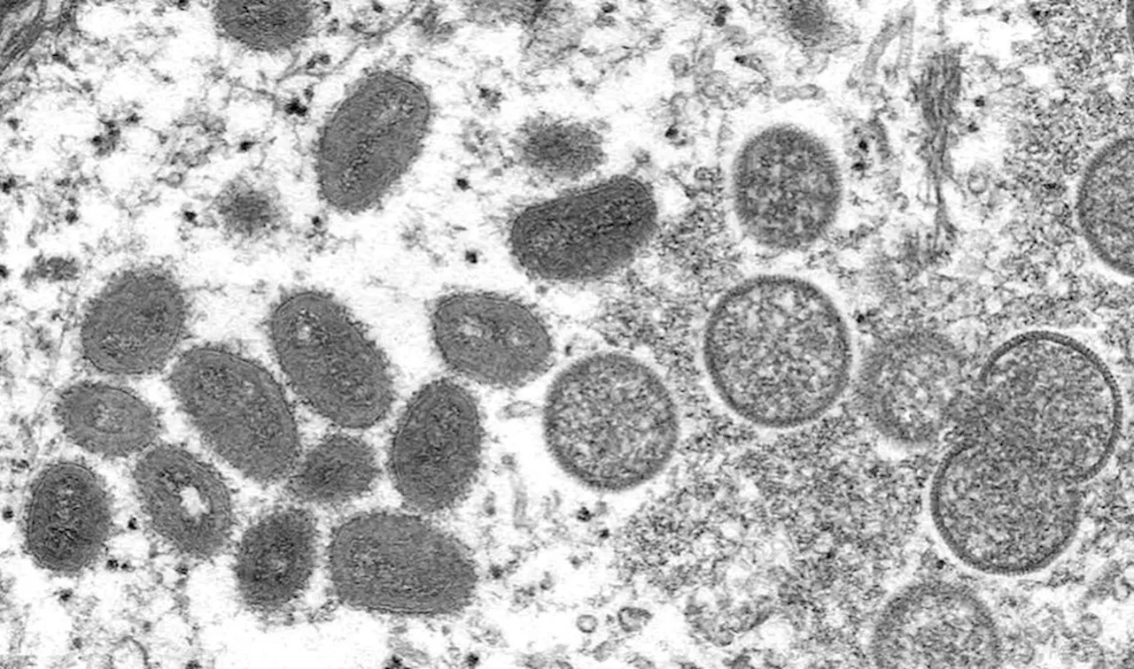 “No momento, não é razoável comparar mpox com Covid-19”, diz presidente da Anvisa à CNN