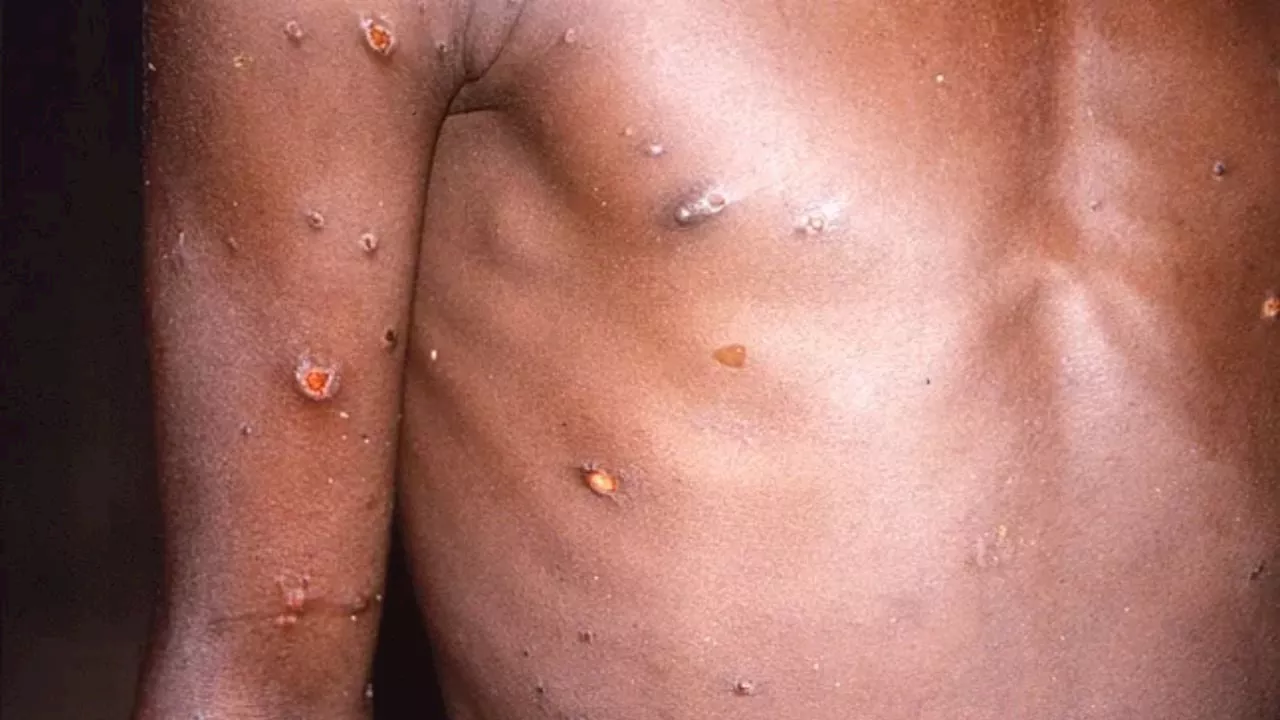 Ssa pide a unidades médicas alertar sobre casos de mpox