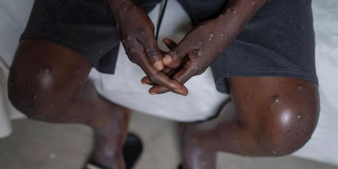 H&ouml;chste Alarmstufe wegen Mpox - was bedeutet das?