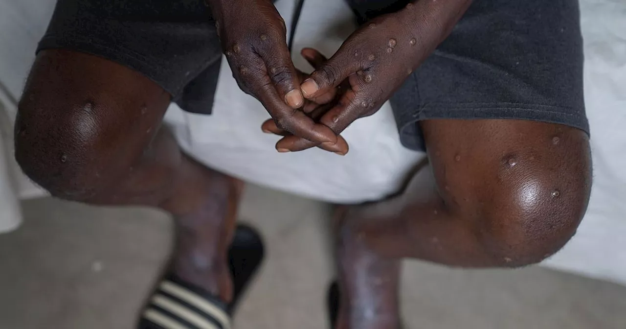 Höchste Alarmstufe wegen Mpox - was bedeutet das?