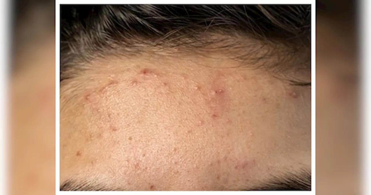 Forehead Acne: माथे पर निकल आए हैं मुहांसे? ये घरेलू उपाय हैं कारगर, तुरंत करते हैं असर