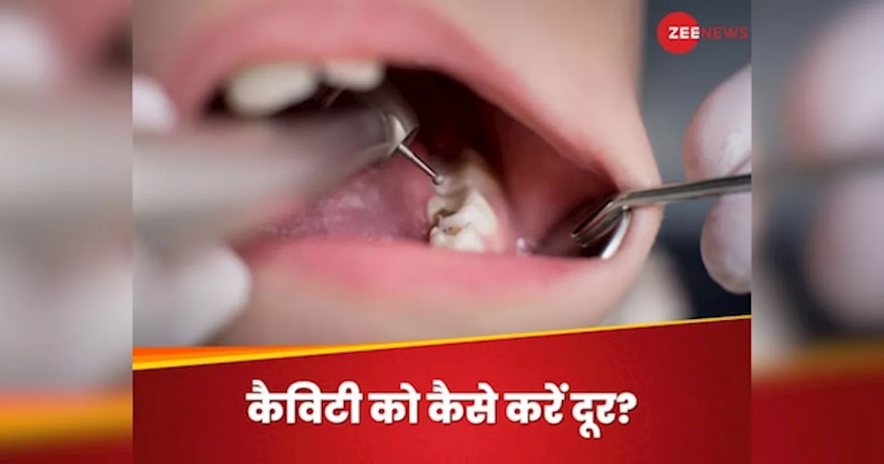 Teeth Cavity: दांतों की सड़न के कारण बंद रखना पड़ता है मुंह? जानिए कैसे पाएं कैविटी फ्री स्माइल