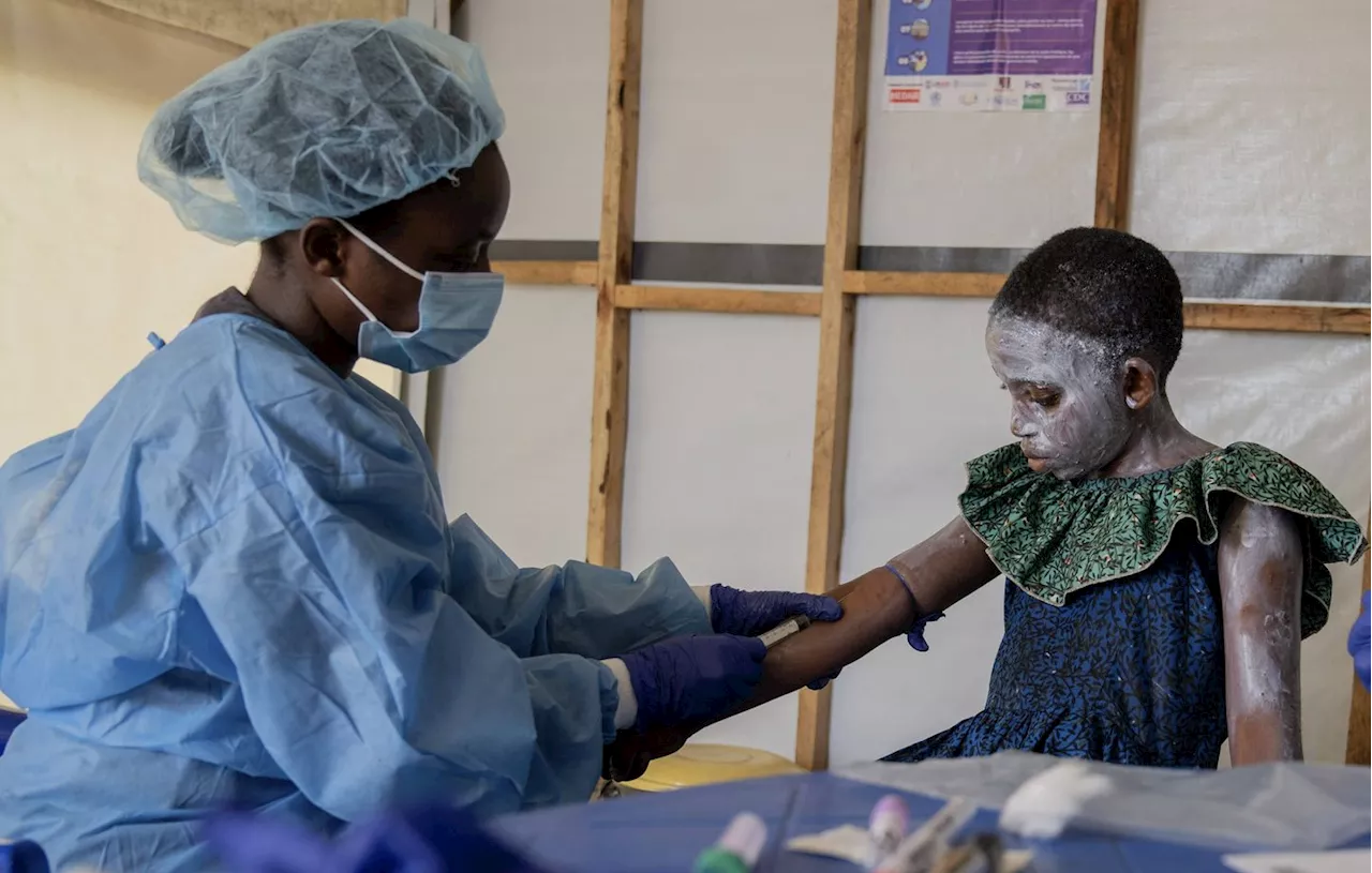 Mpox : Près de 19.000 cas et 541 morts en Afrique depuis le début de l’année