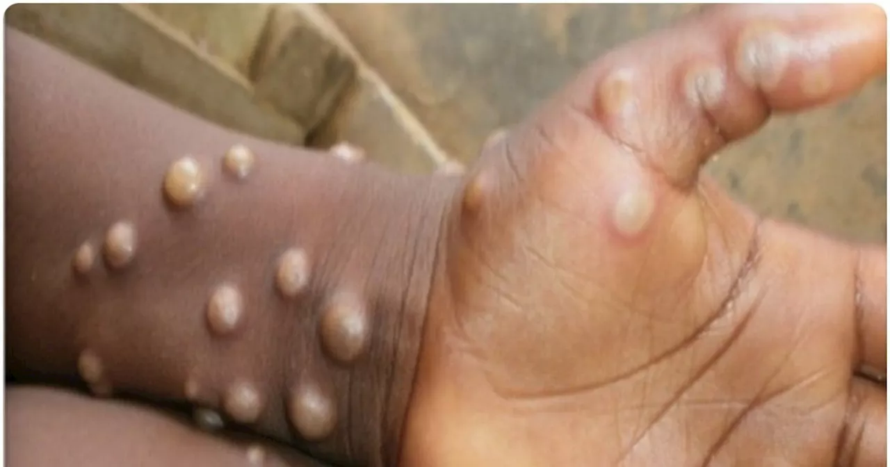 Monkeypox: क्या भारत में संक्रमण का खतरा है? स्वास्थ्य मंत्रालय की रिव्यू मीटिंग में मंकीपॉक्स पर क्या फैसल...