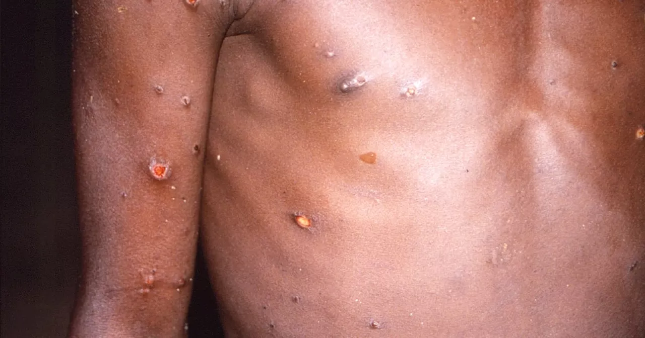 ‘Sufficient’ supplies of mpox vaccine for State to counter risk deemed low by health officials