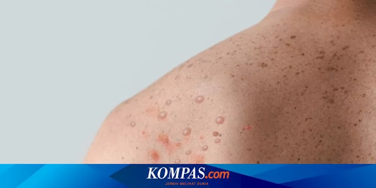 Waspada, Kenali 5 Cara Penularan Wabah Mpox Berikut Ini