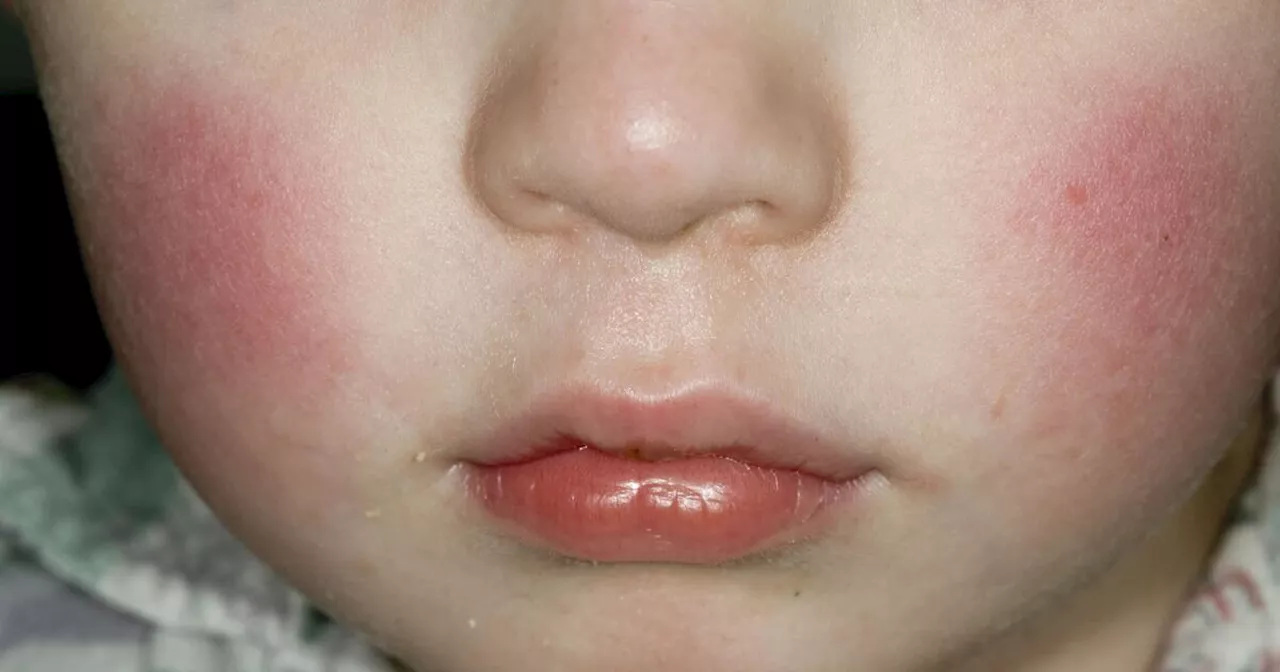 What to know about the 'slapped cheek' virus uptick in the U.S.
