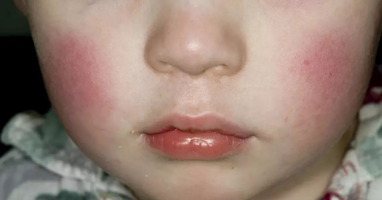 What to know about the 'slapped cheek' virus uptick in the U.S.