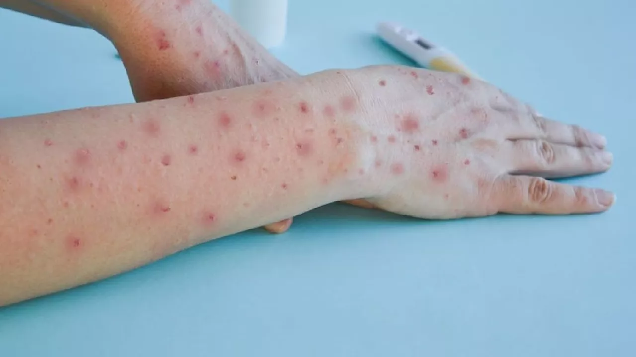 Monkeypox Virus: मंकीपॉक्स को WHO ने घोषित किया 'पब्लिक हेल्थ इमरजेंसी', चपेट में आए 116 देश