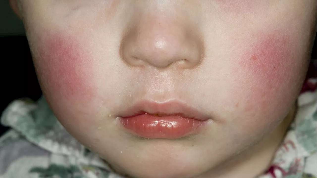 What to know about the 'slapped cheek' virus uptick in the U.S.