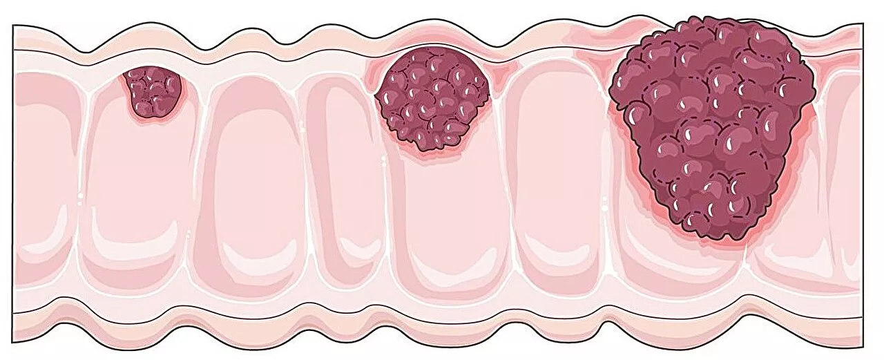 Study charts the incidence and mortality of digestive system cancers in China