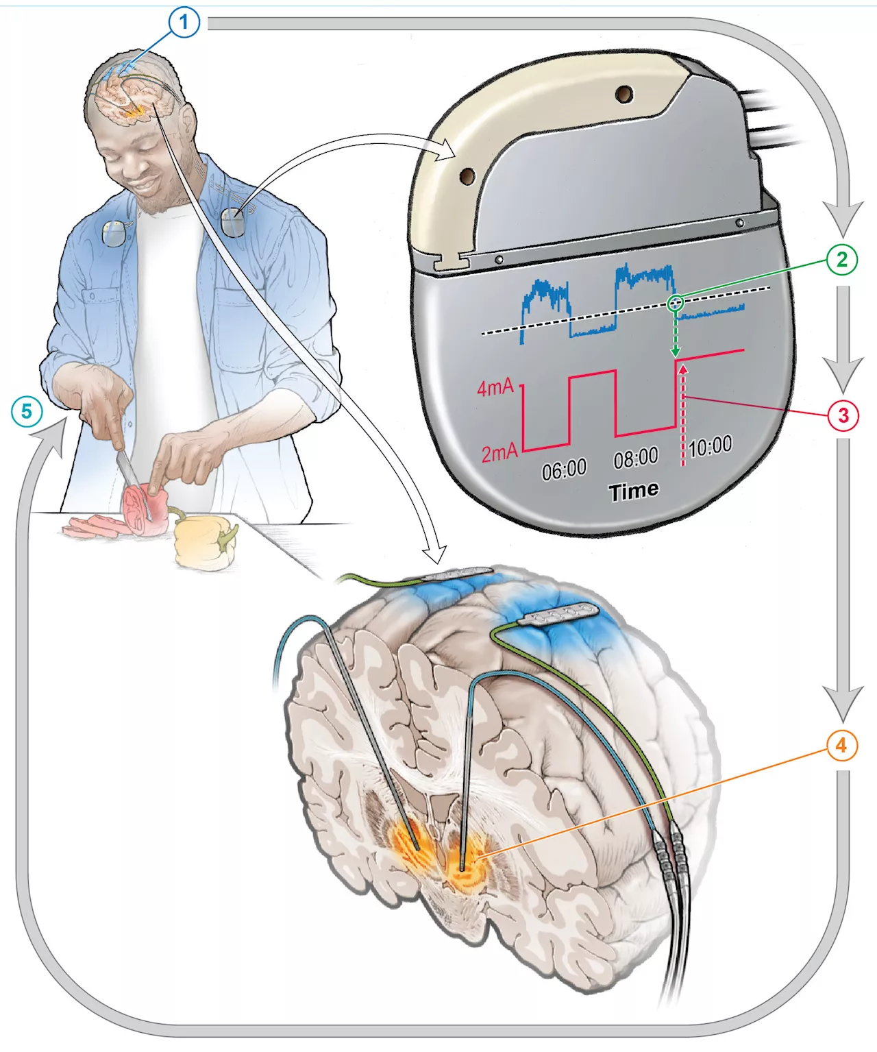 Taming Parkinson's disease with self-adjusting brain pacemakers