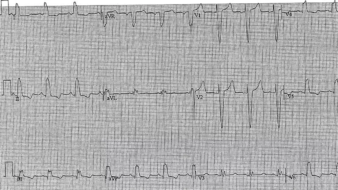 ECG Challenge: Crackling Lung Sounds and Edema