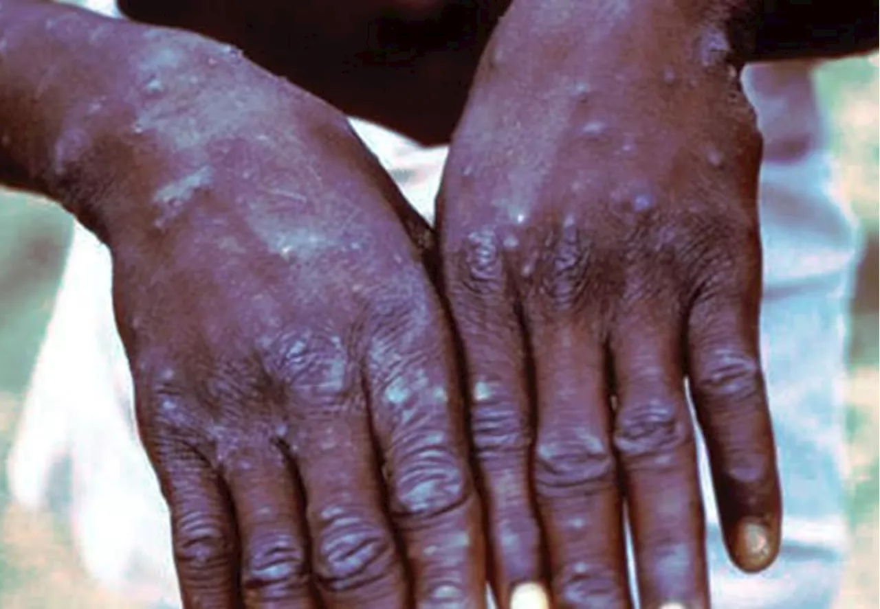 'Do not panic' -- resident doctors ask Nigerians to report mpox cases to health agencies