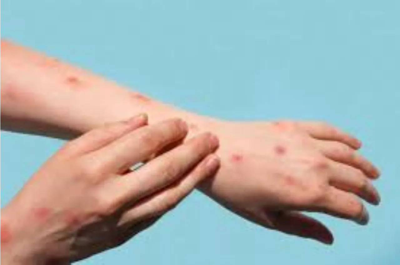 Department of Health assures South Africans Mpox is under control