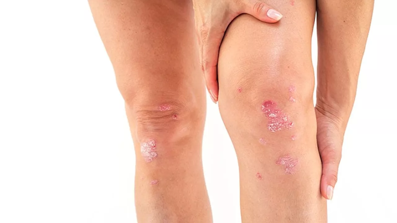 Psoriatic Arthritis Risk Similar With IL-23 and IL-12/23 Inhibitors