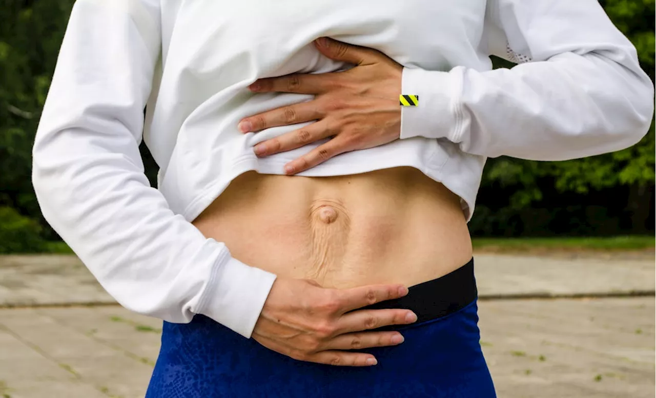 Diastase abdominale : quand les muscles s'écartent