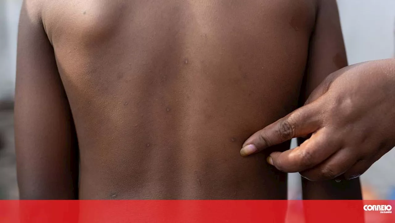 OMS tenta transmitir tranquilidade perante surto de Mpox em África e um caso na Europa