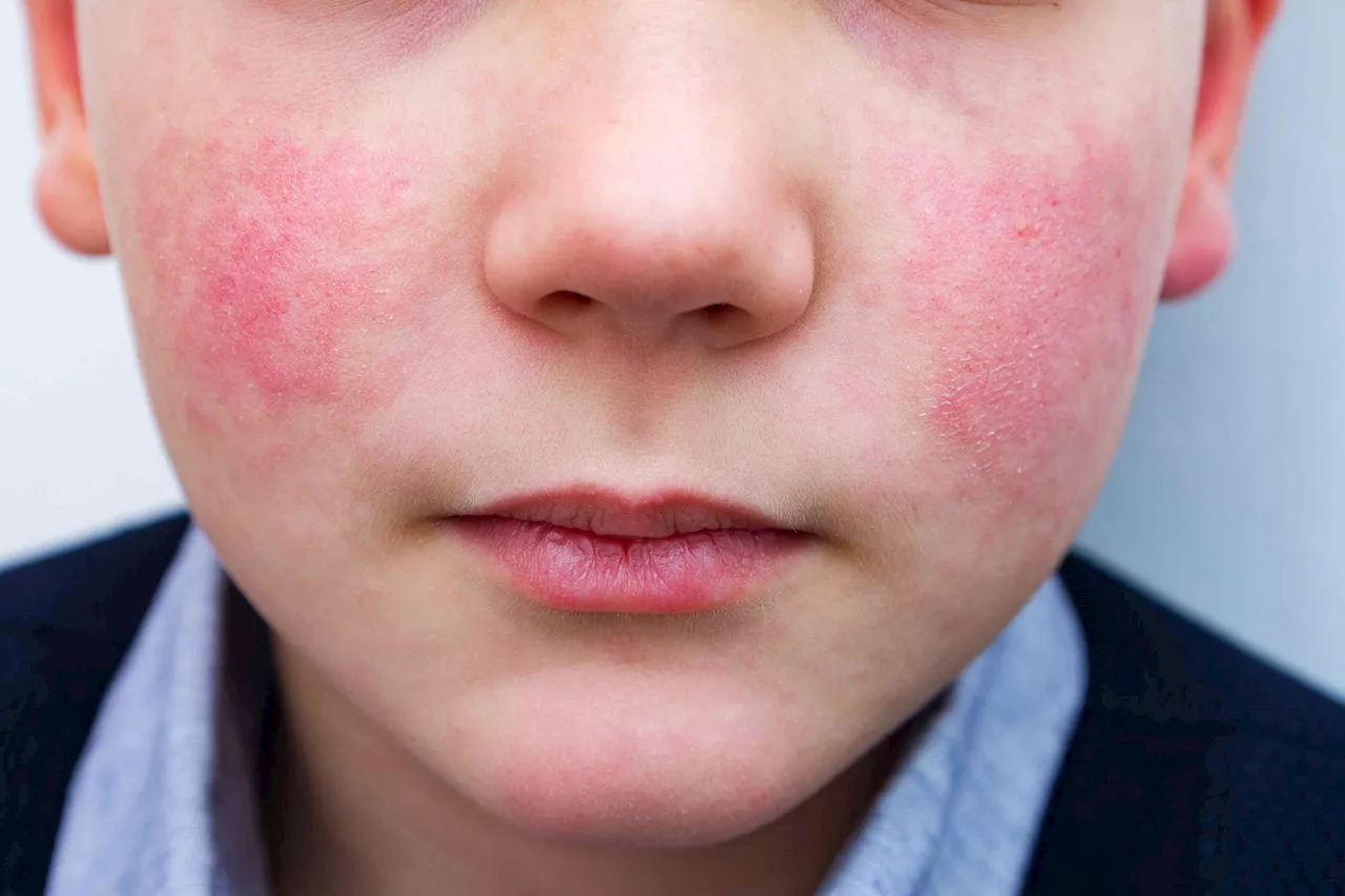 'Slapped Cheek' Virus: CDC Issues Warning Over Spike in Human Parvovirus Cases
